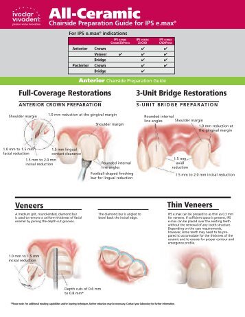 emax chairside prep guide - Glidewell Dental Labs