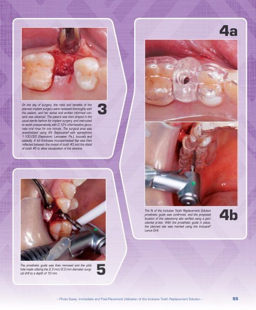 PDF Download - Glidewell Dental Labs