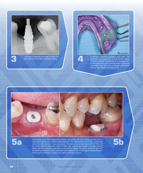 PDF Download - Glidewell Dental Labs