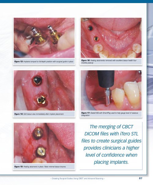 PDF Download - Glidewell Dental Labs