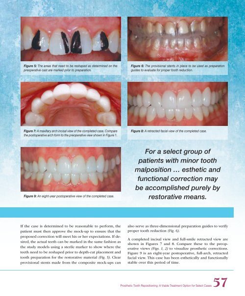 PDF Version - Glidewell Dental Labs