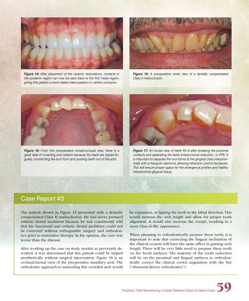 PDF Version - Glidewell Dental Labs