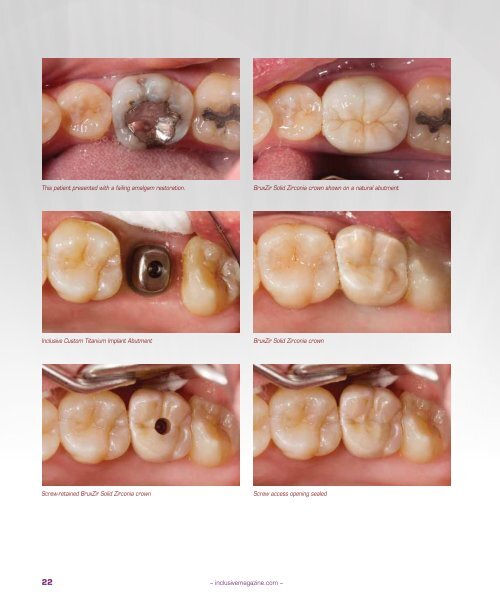 PDF Download - Glidewell Dental Labs