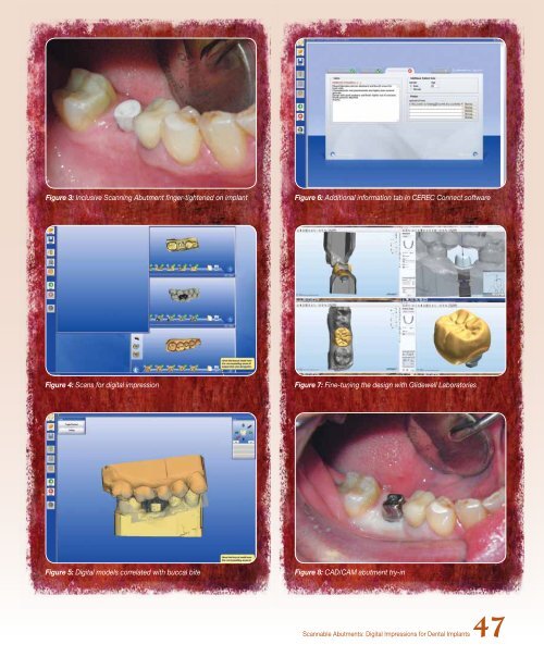 PDF Version - Glidewell Dental Labs