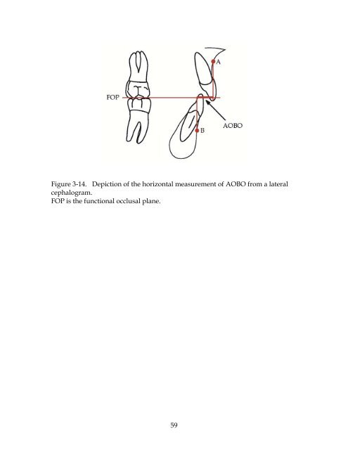 EFFICACY OF TEMPORARY FIXED RETENTION FOLLOWING ...