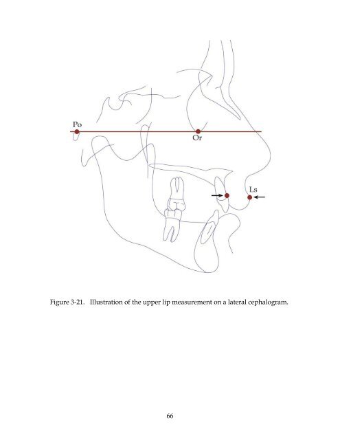 EFFICACY OF TEMPORARY FIXED RETENTION FOLLOWING ...