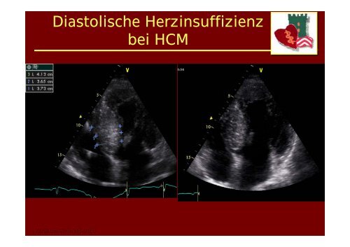 Die andere Kardiomyopathie: Differentialdiagnose und ... - theHeart.de