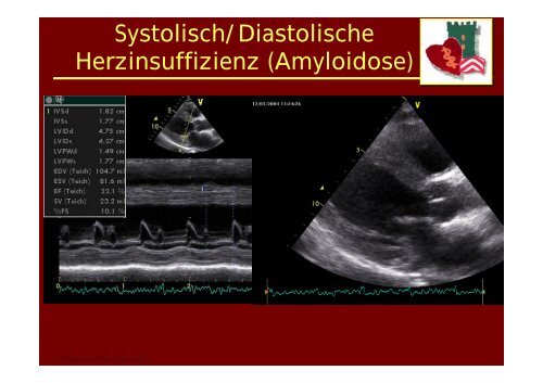 Die andere Kardiomyopathie: Differentialdiagnose und ... - theHeart.de