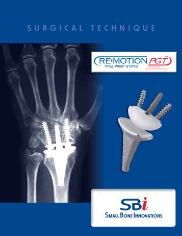 Download the RE-MOTIONâ¢ Surgical Technique - Small Bone ...
