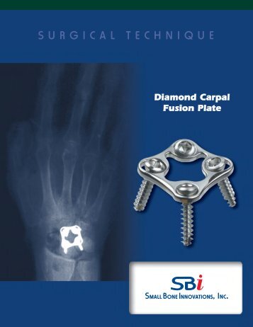 SURGICAL TECHNIQUE - Small Bone Innovations