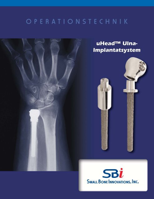 uHeadâ¢ Operationstechnik - Small Bone Innovations