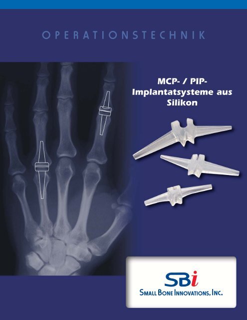 Download Surgical Technique - Small Bone Innovations