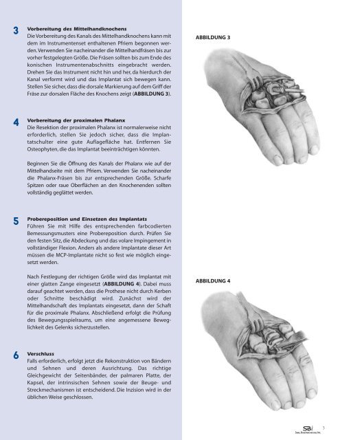 Download Surgical Technique - Small Bone Innovations