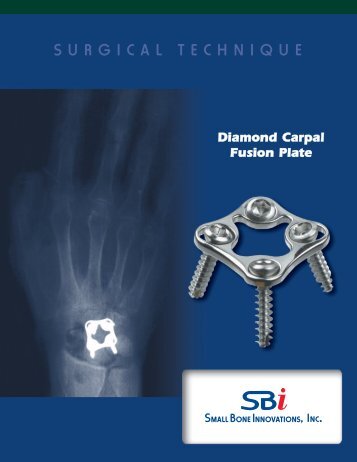 Diamond Carpal Fusion Plate - Small Bone Innovations