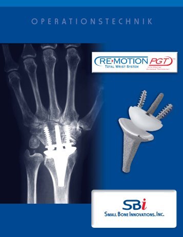 RE-MOTIONâ¢-Operationstechnik - Small Bone Innovations