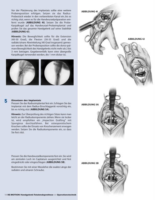 RE-MOTIONâ¢-Operationstechnik - Small Bone Innovations