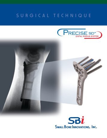 Precise SDâ¢ Surgical Technique - Small Bone Innovations