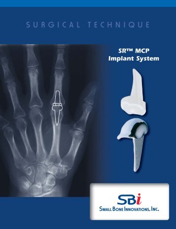 Download Surgical Technique - Small Bone Innovations