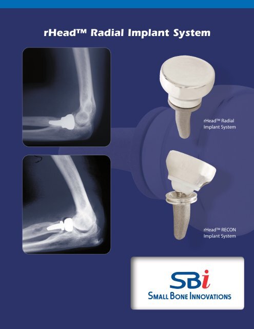 rHeadâ¢ Radial Implant System - Small Bone Innovations