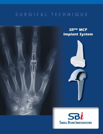 SRâ¢ MCP Implant System - Small Bone Innovations