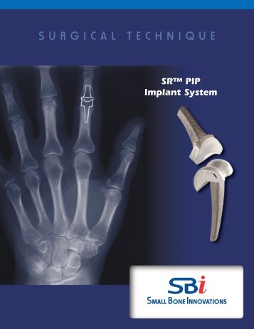 SRâ¢ PIP Implant System Surgical Technique - Small Bone ...