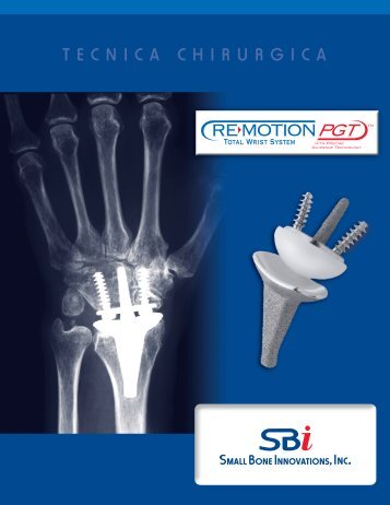 Download the RE-MOTIONâ¢ Surgical Technique - Small Bone ...