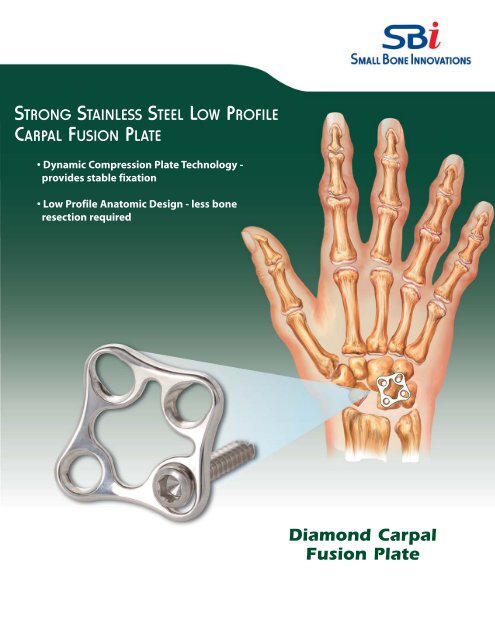 Diamond Carpal Fusion Plate - Small Bone ... - Ortomed Import