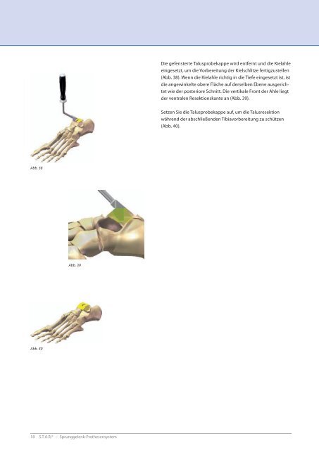 [SBi] STARÂ® Operationstechnik | 26.02.2010 - Small Bone Innovations