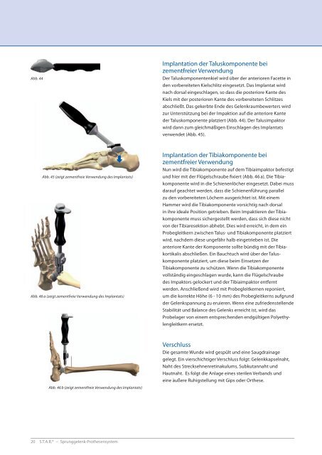 [SBi] STARÂ® Operationstechnik | 26.02.2010 - Small Bone Innovations