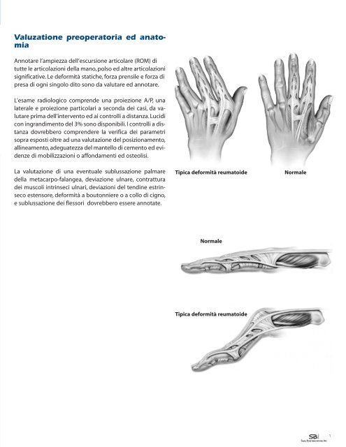 SRâ¢ MCP Sistema Protesico - Small Bone Innovations