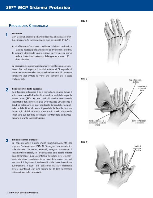 SRâ¢ MCP Sistema Protesico - Small Bone Innovations