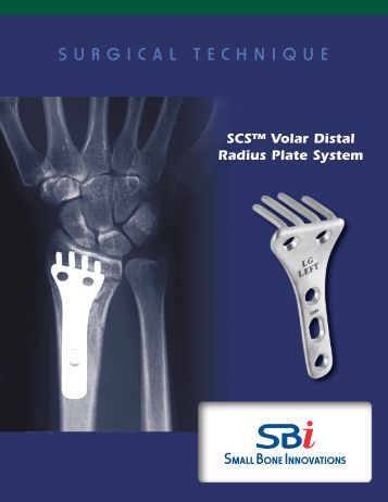 results of volar locking plate osteosynthesis for distal radial fractures Results the baseline with volar locking plate fixation for patients treatment of distal radial fractures with a volar locking plate versus. results of volar locking plate osteosynthesis for distal radial fractures Results the baseline with volar locking plate fixation for patients treatment of distal radial fractures with a volar locking plate versus.