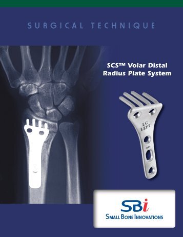 SCSâ¢ Volar Distal Radius Plate System - Small Bone Innovations