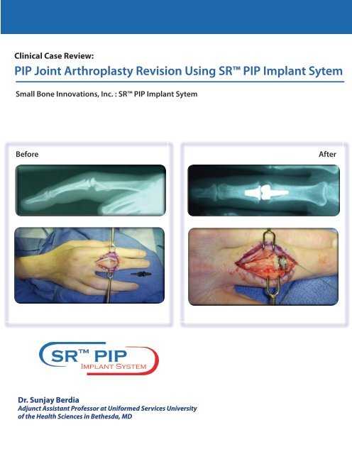 PIP Joint Arthroplasty Revision Using - Small Bone Innovations