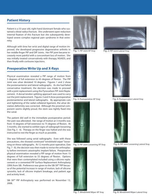 PIP Joint Arthroplasty Revision Using - Small Bone Innovations