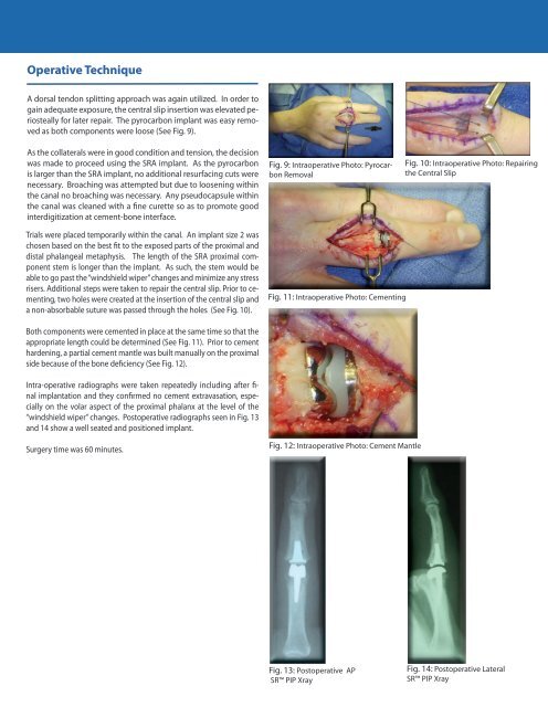 PIP Joint Arthroplasty Revision Using - Small Bone Innovations