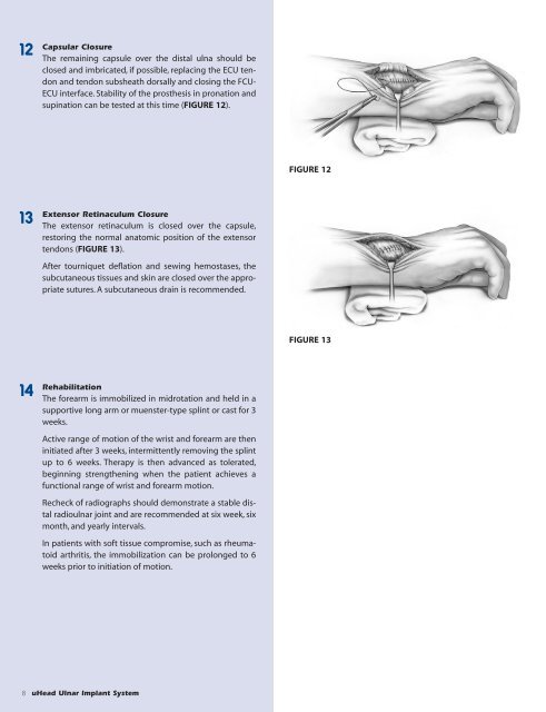 Download the uHead Surgical Technique - Small Bone Innovations