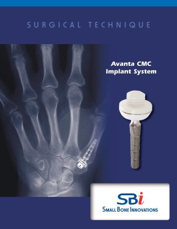 Download the - Small Bone Innovations