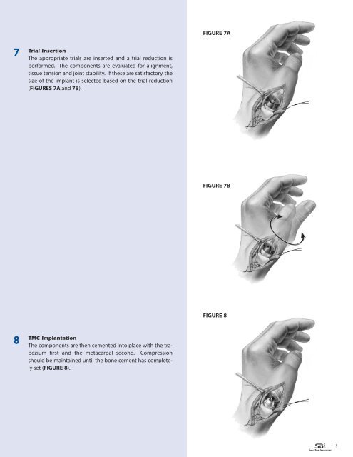 Download the - Small Bone Innovations