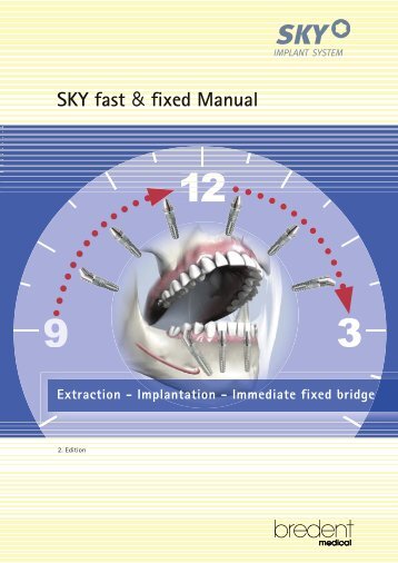 SKY fast & fixed Manual - bredent medical GmbH & Co.KG