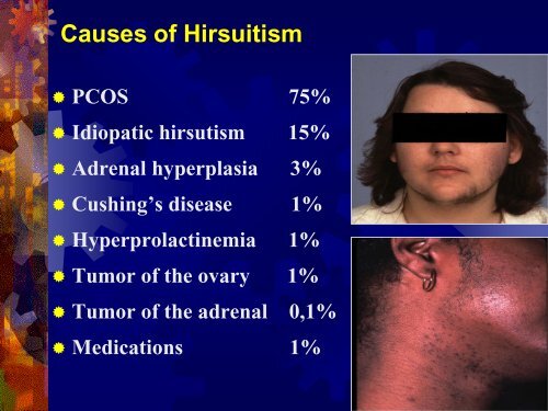 Hirsutism & Virilization