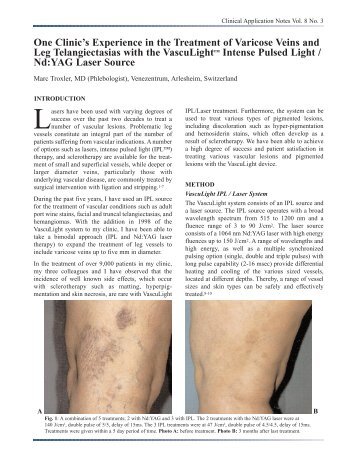 Treatment of Varicose Veins (.pdf) - Lumenis Aesthetic