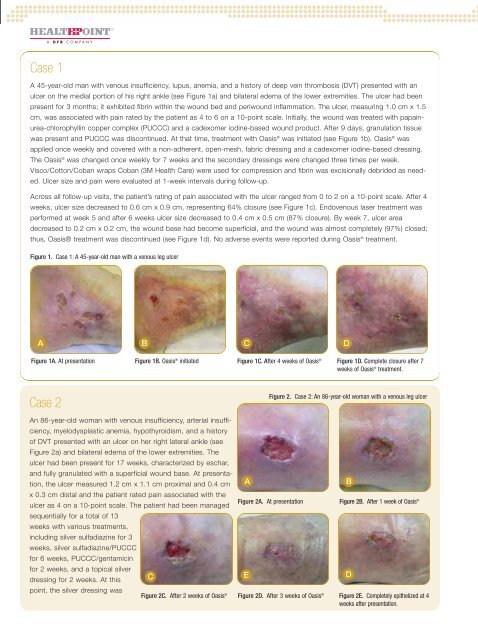 Clinical Experience with OasisÂ® Wound Matrix for the Treatment of ...