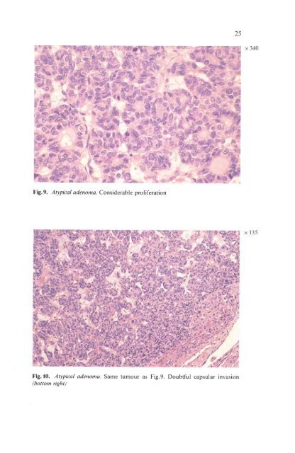 Histological Typing of Thyroid Tumours - libdoc.who.int - World ...