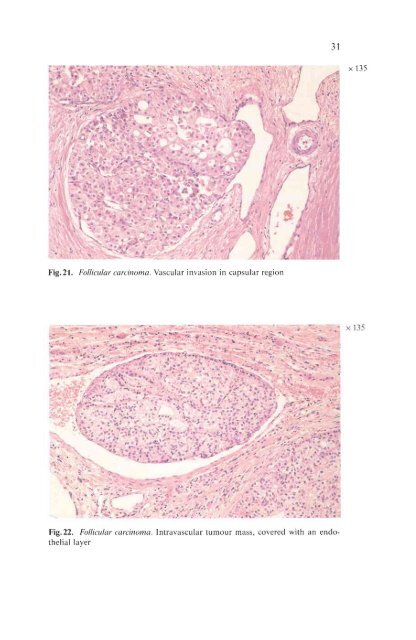 Histological Typing of Thyroid Tumours - libdoc.who.int - World ...