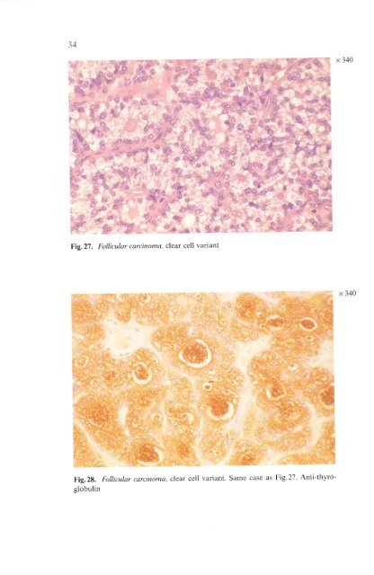 Histological Typing of Thyroid Tumours - libdoc.who.int - World ...