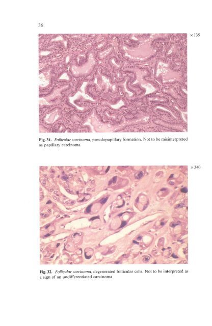 Histological Typing of Thyroid Tumours - libdoc.who.int - World ...