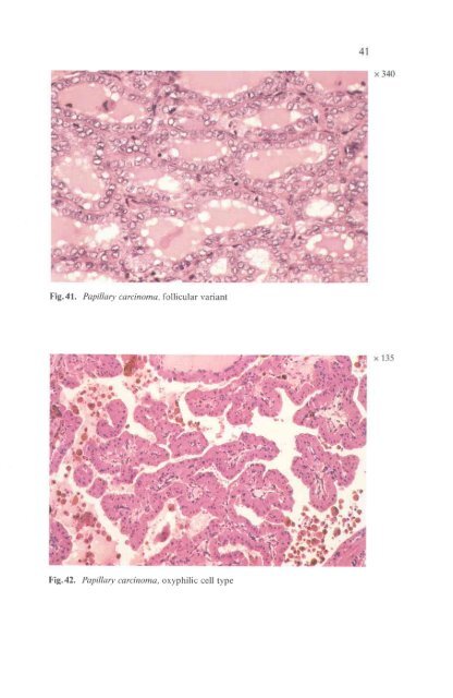 Histological Typing of Thyroid Tumours - libdoc.who.int - World ...