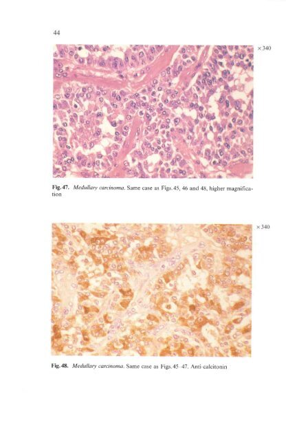 Histological Typing of Thyroid Tumours - libdoc.who.int - World ...