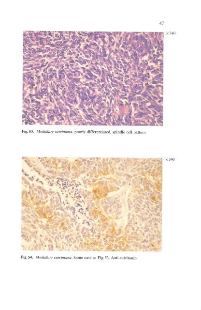 Histological Typing of Thyroid Tumours - libdoc.who.int - World ...